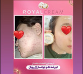 کرم روشن کننده و ضدلک رویال همراه با صابون